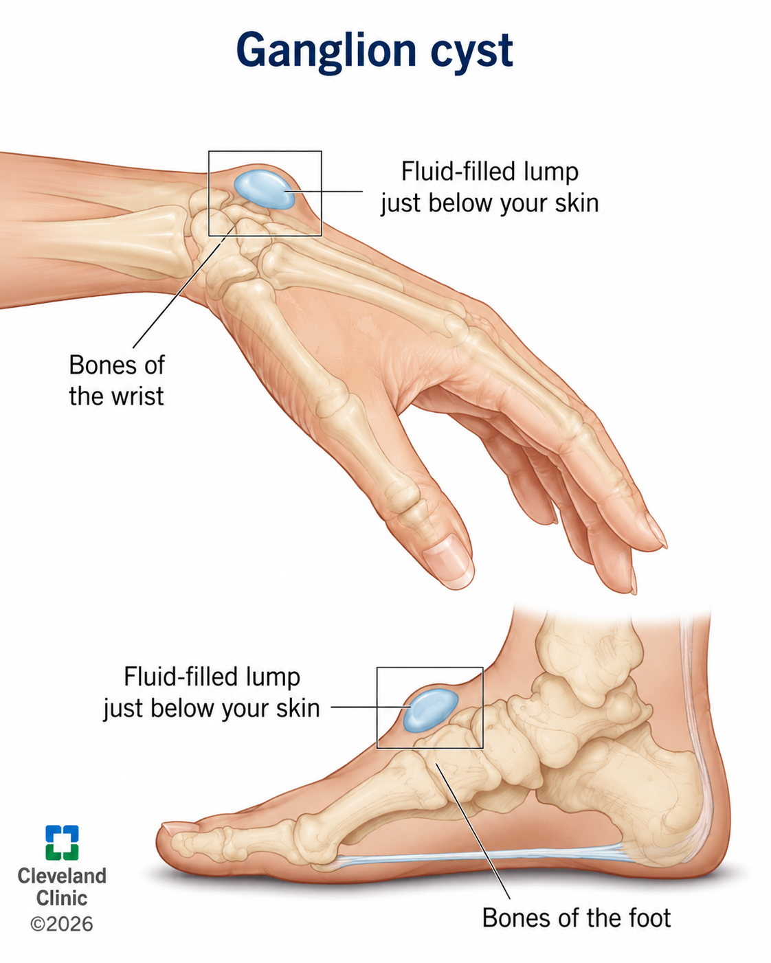 Ganglion Cysts Overview
